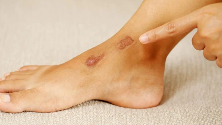 Cara Menghilangkan Bekas Luka di Kaki Dengan Cepat dan Alami