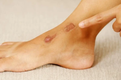 Cara Menghilangkan Bekas Luka di Kaki Dengan Cepat dan Alami
