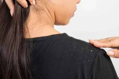 Cara Menghilangkan Ketombe Berkerak di Kepala yang Alami