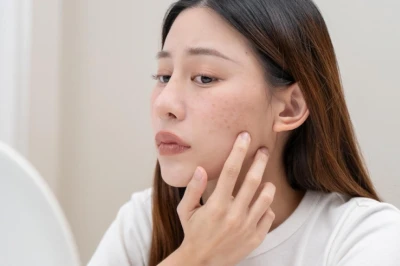9 Cara Jitu Menghilangkan Bruntusan Tanpa Bekas di Wajah